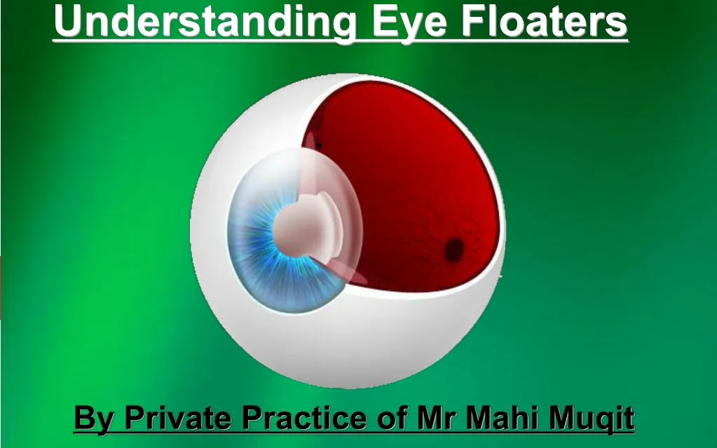 understanding eye floaters