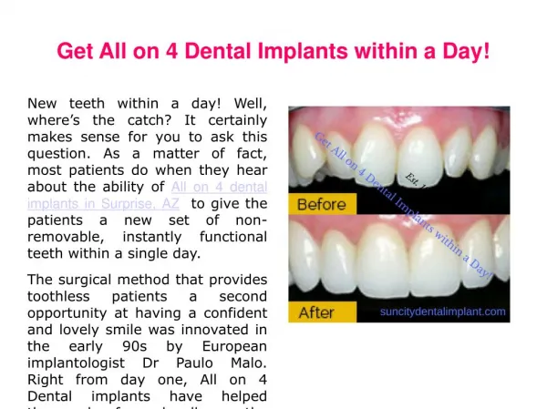 Get All on 4 Dental Implants within a Day!
