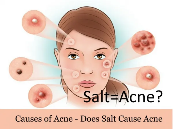 Causes of Acne - Does Salt Cause Acne