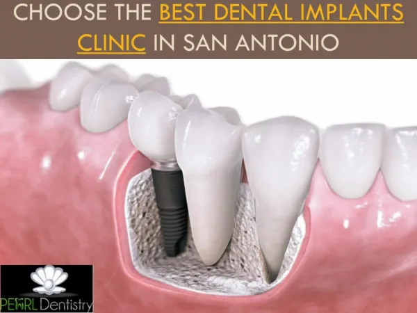 Choose the Best Dental Implants Clinic in San Antonio