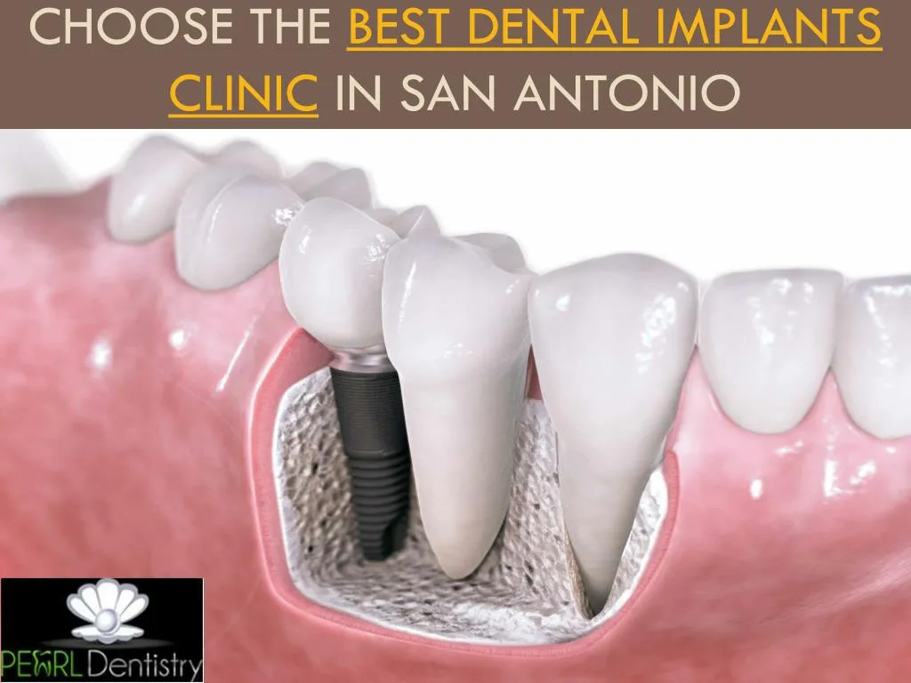 choose the best dental implants clinic in san antonio