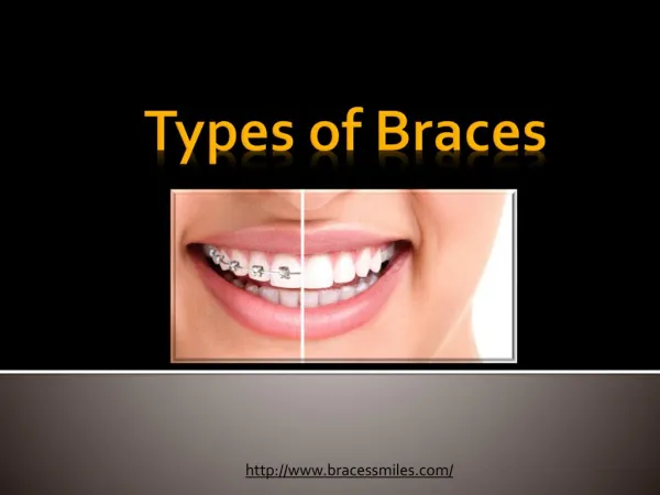 Types of Braces by Braces & Smiles Orthodontic and Dental Care Dentist in Pune