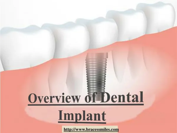 Overview of Dental Implant by Braces & Smiles Orthodontic and Dental Care Dentist in Pune