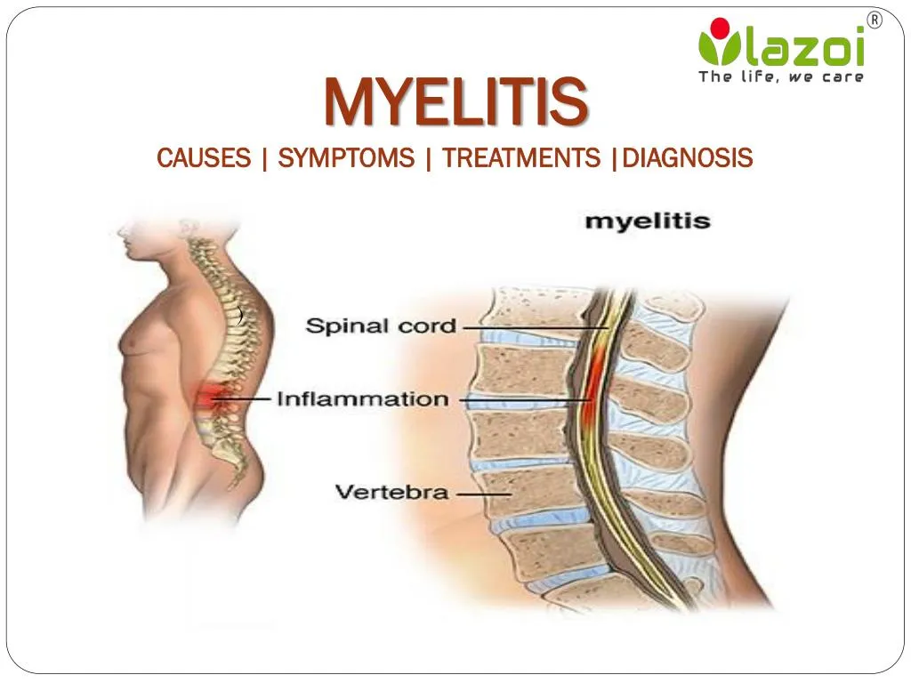 myelitis causes symptoms treatments diagnosis