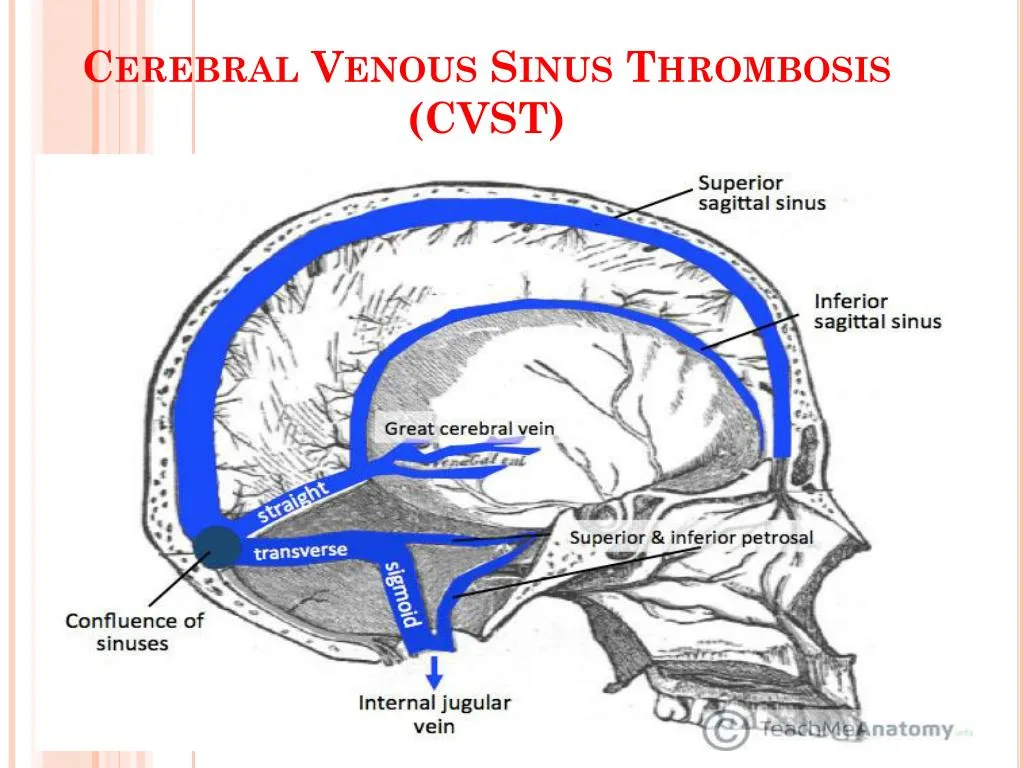 cerebral venous sinus thrombosis cvst