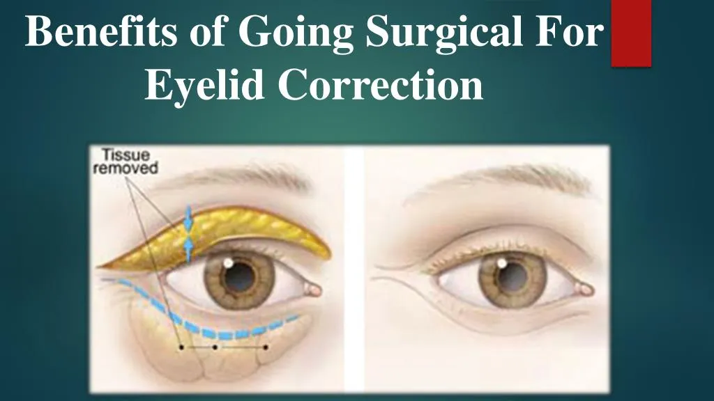 benefits of going surgical for eyelid correction