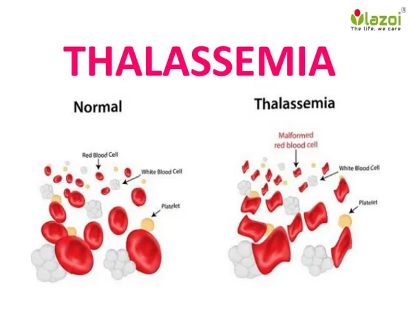 Thalessemia : Overview, Symptoms, complications, Risk factor, Causes, Daignosis and Treatment