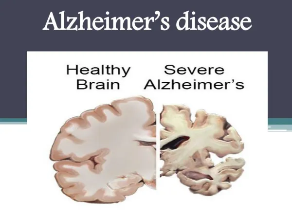 Alzheimer's disease : Overview, Symptoms, Risk Factor, Causes, Treatment and diagnosis