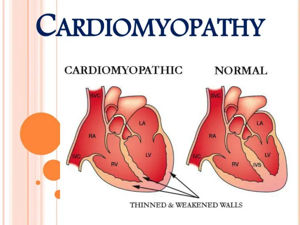 Heart Muscle Disease (Cardiomyopathy)