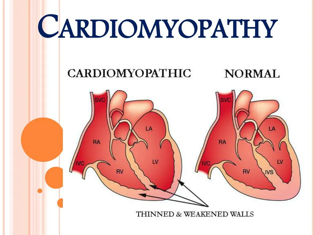 cardiomyopathy