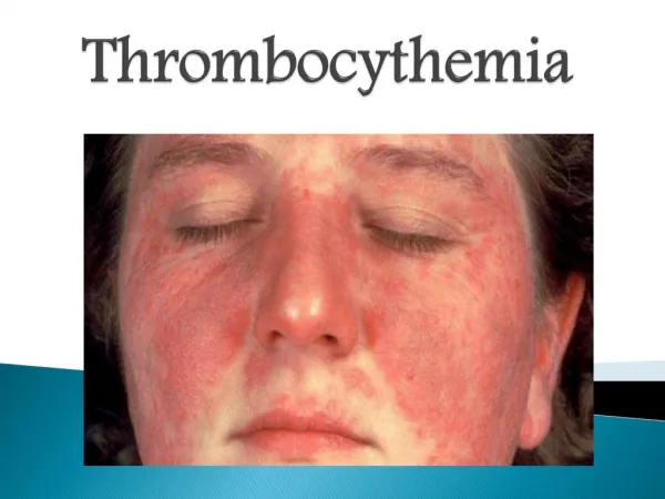 Thrombocythemia: Causes, Symptoms, Diagnosis, and Treatment