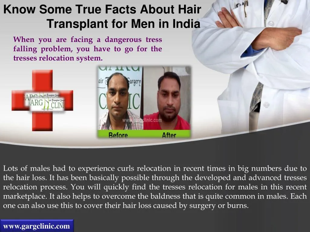 know some true facts about hair transplant for men in india