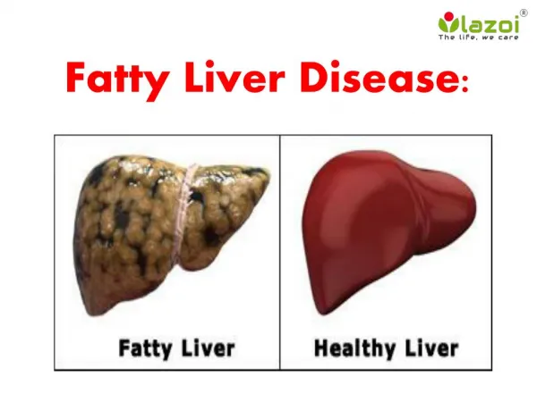 Fatty Liver Disease: Information on symptoms, causes and treatment