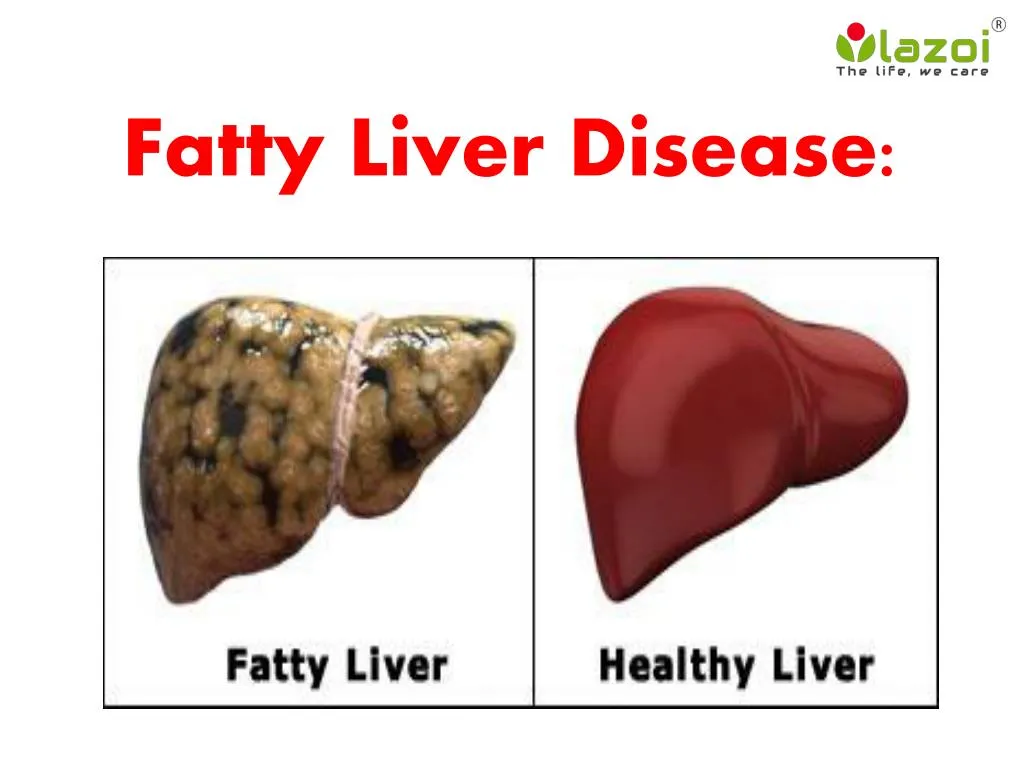 fatty liver disease