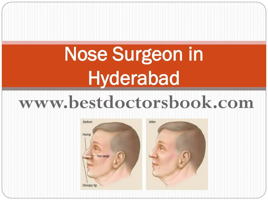 nose surgeon in hyderabad