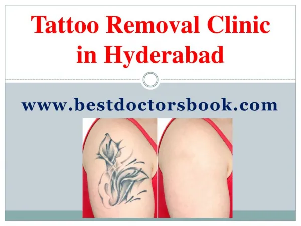Tattoo Removal Clinic in Hyderabad | Tattoo Removal Hyderabad