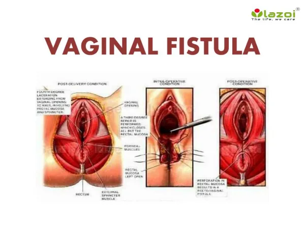 Vaginal Fistula: Causes, Symptoms, Diagnosis, and Treatment