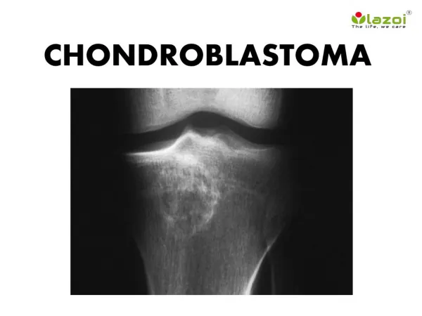 Chondroblastoma: Symptoms, Causes, Diagnosis and Treatment