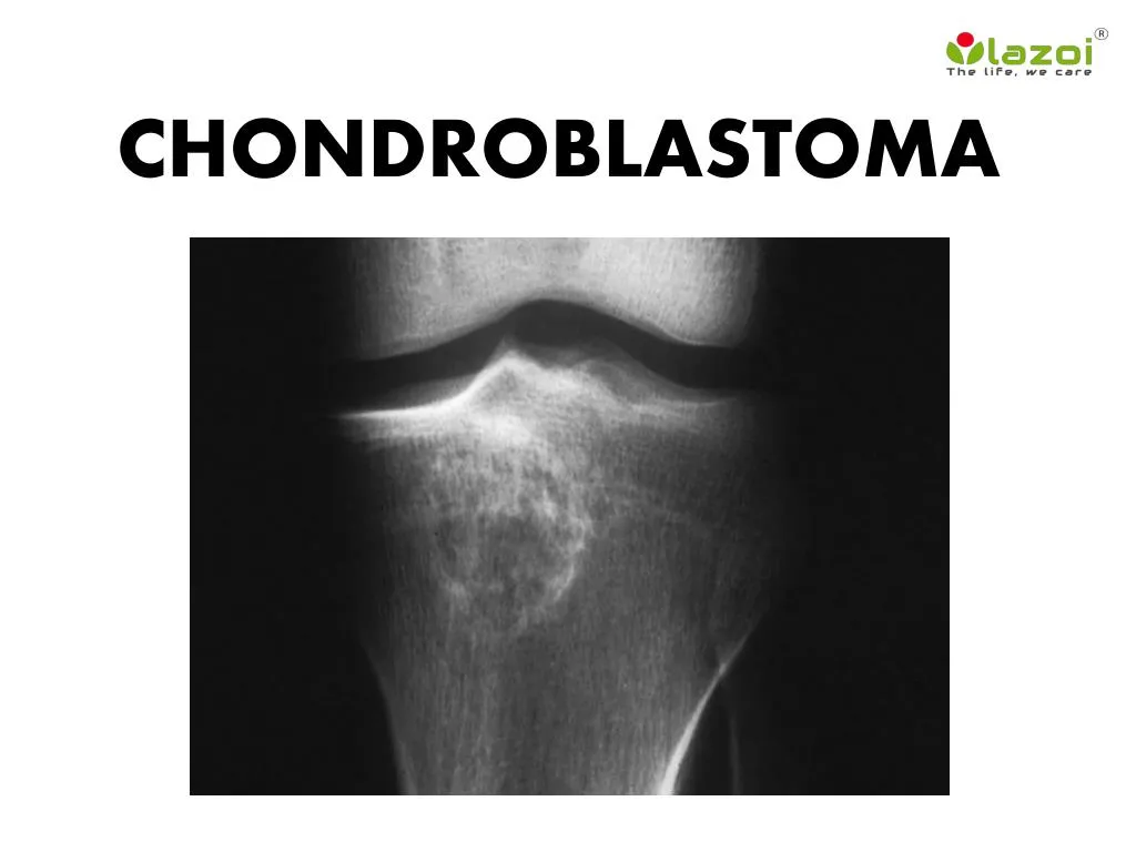 chondroblastoma