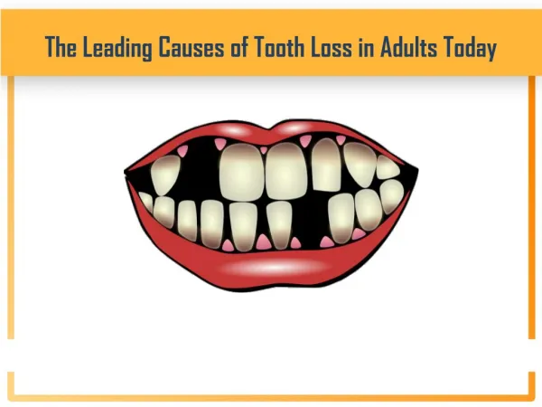 The Leading Causes of Tooth Loss in Adults Today