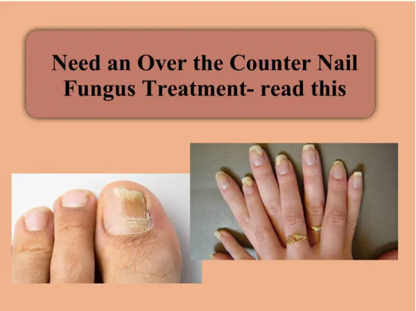 Need an Over the Counter Nail Fungus Treatment- read this