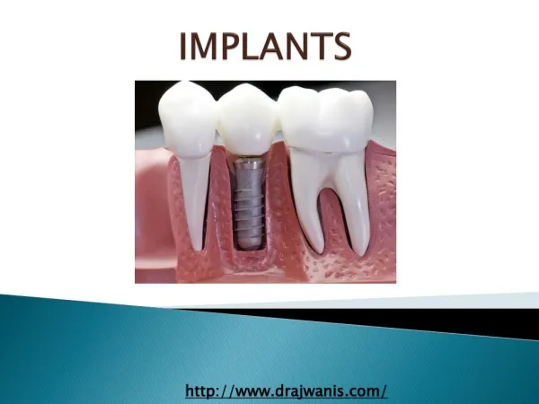 Overview of Dental Implant By Pune’s Cosmetic Dentist - Dr. Ajwani