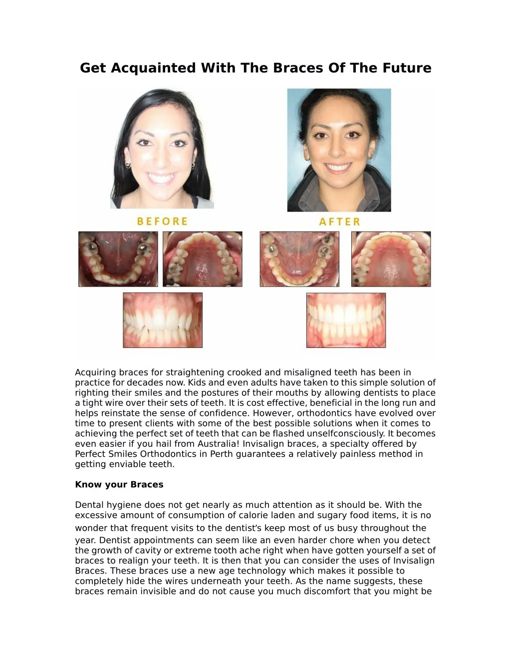 get acquainted with the braces of the future