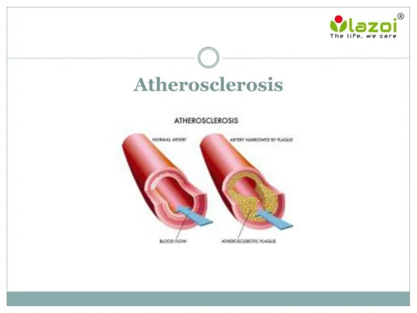 atherosclerosis