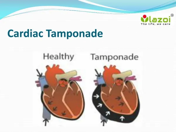 Cardiac Tamponade: Overview, Symptoms, Signs, Causes, Risk factor, Diagnosis and Treatment