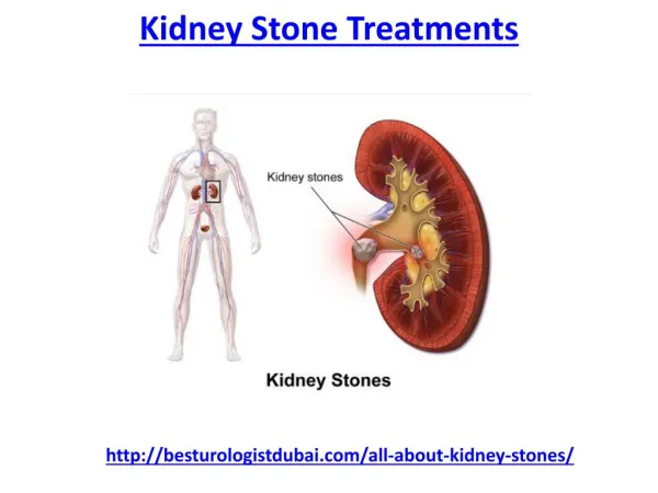 where you get the best kidney stone treatments in Dubai