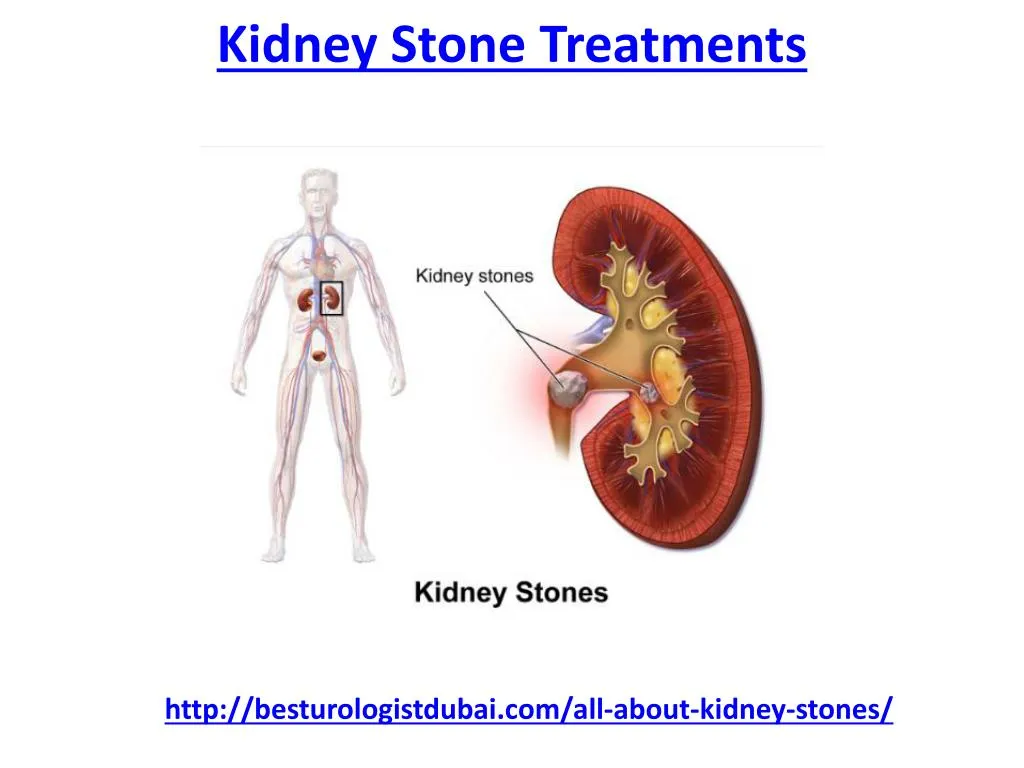 kidney stone treatments