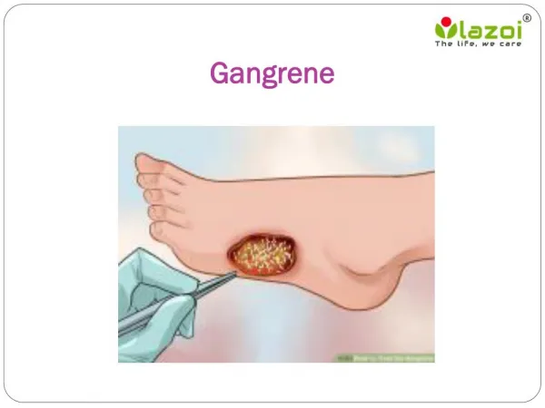 Gangrene : Overview, symptoms, causes, diagnosis and treatment