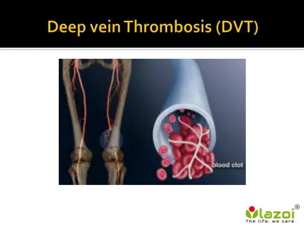 Deep vein Thrombosis (DVT)
