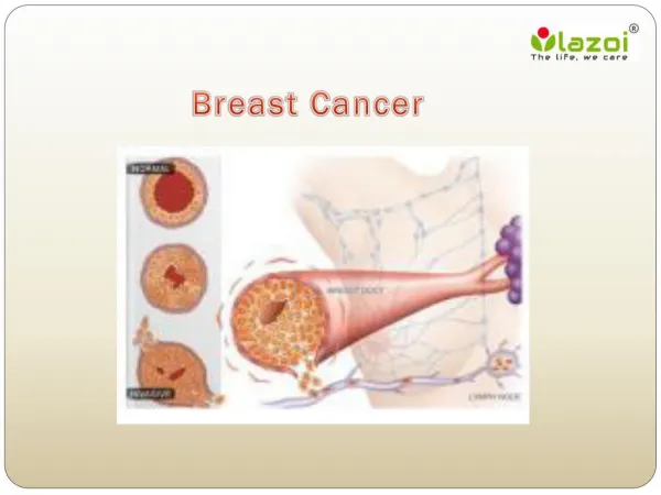 Breast Cancer : Overview of symptoms, causes, diagnosis, risk factor and treatment