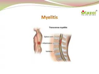Myelitis : Overview, causes, types, symptoms, diagnosis and treatment - slide 1