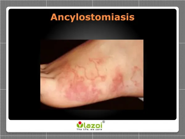 Ancylostomiasis - Symptoms, Treatments and Preventions