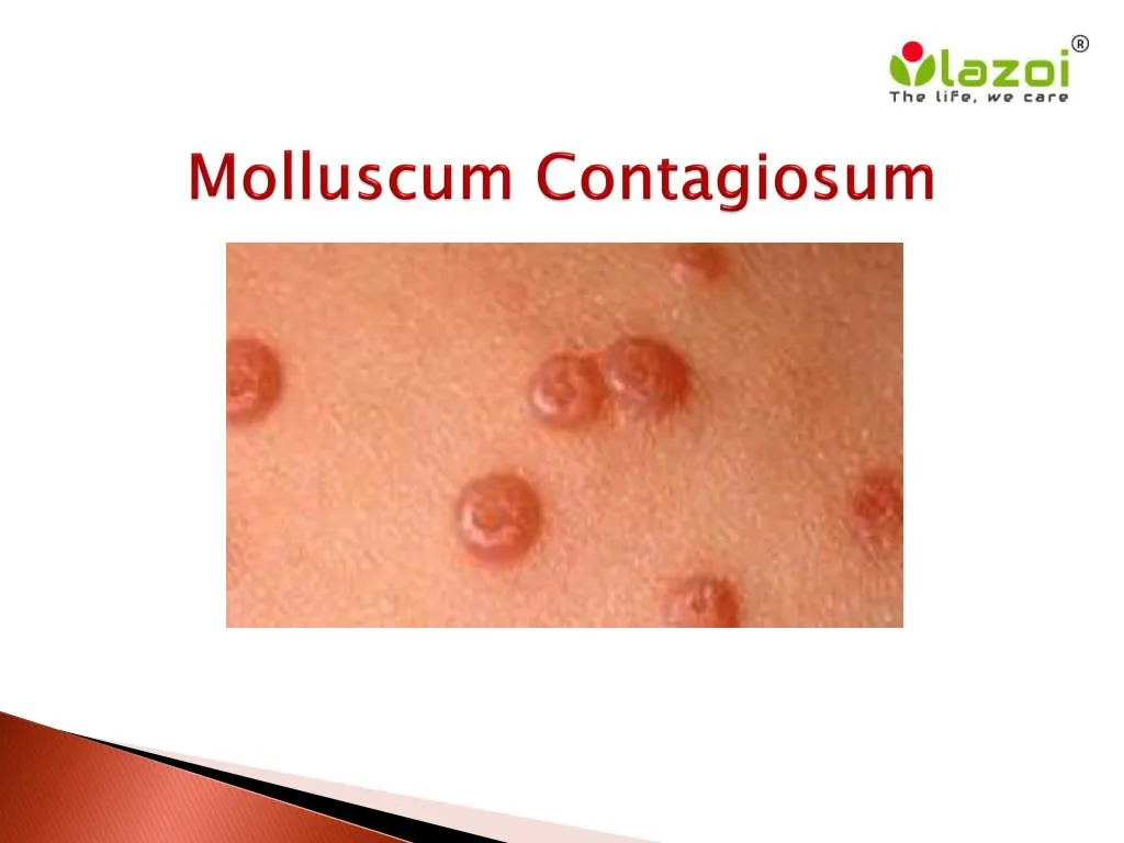 molluscum contagiosum