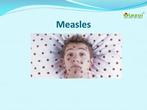 Measles: Causes, Symptoms, Complications and Treatment