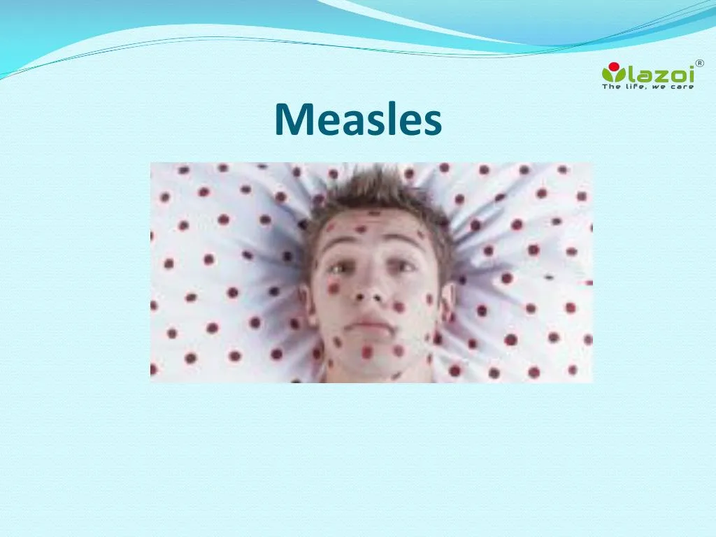 measles