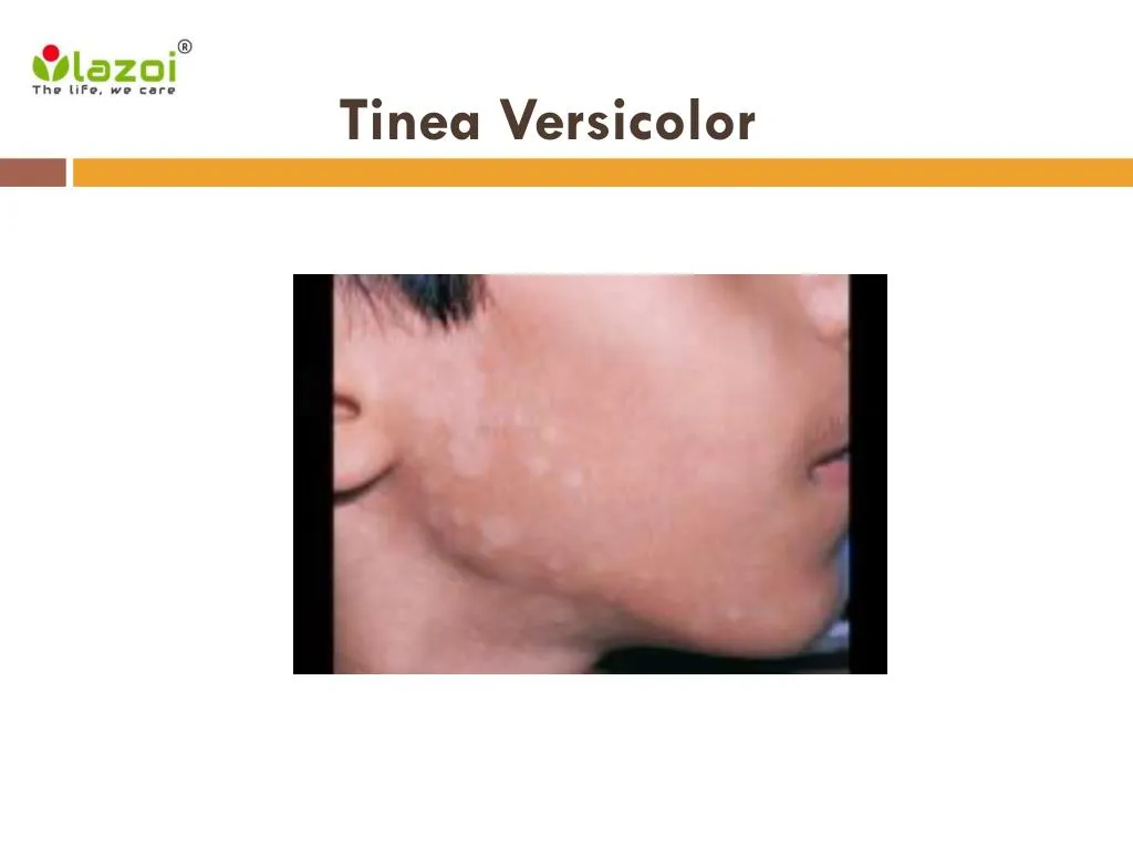 Tinea versicolor - Symptoms and causes