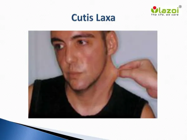Cutis Laxa: Causes, Symptoms, Diagnosis and Treatment