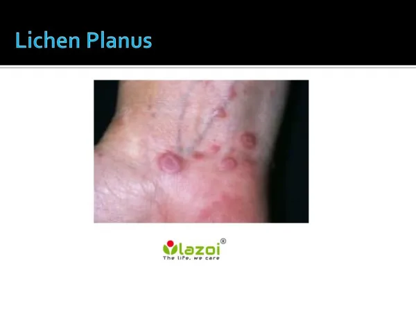 Lichen Planus: Symptoms, Causes, Diagnosis and Treatment