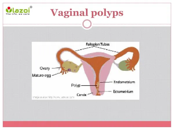 Vaginal polyps : Causes, symptoms, diagnosis and treatment