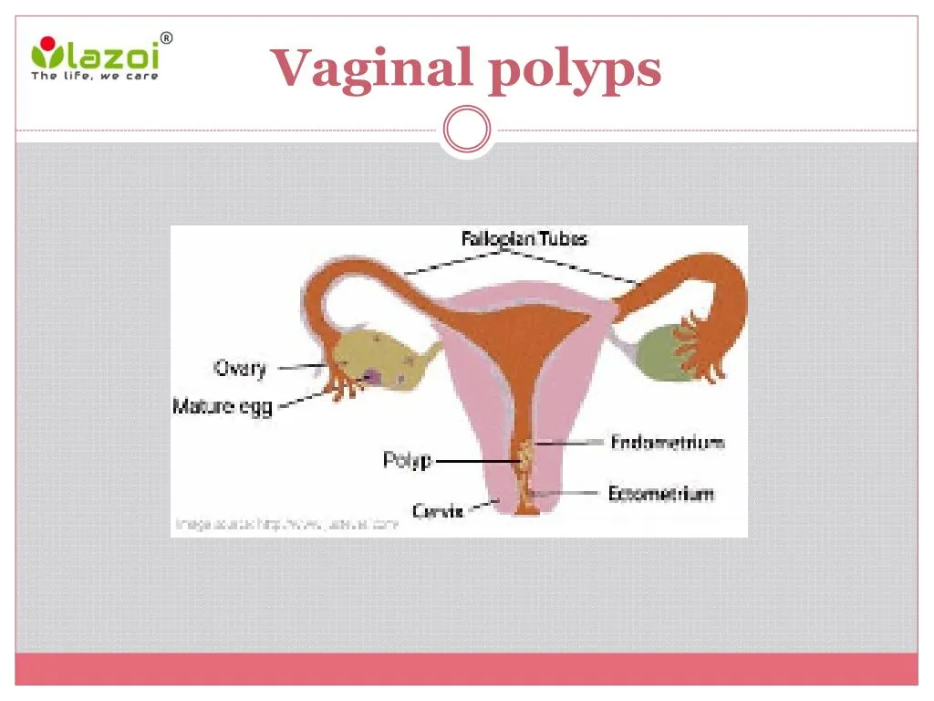 vaginal polyps