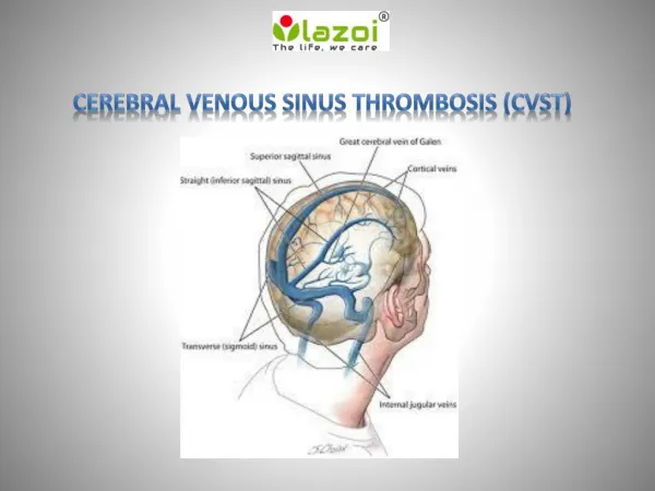 Cerebral Venous Sinus Thrombosis (CVST)