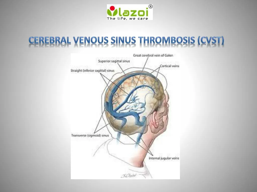 cerebral venous sinus thrombosis cvst