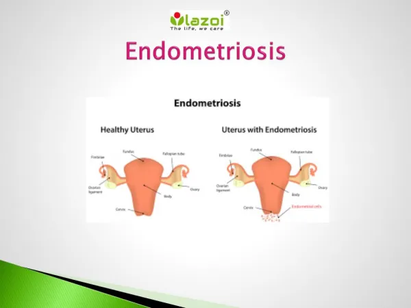 Endometriosis : Overview, Sign, Symptoms, Causes Diagnosis and Treatment.
