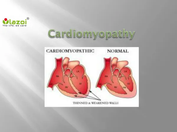 Cardiomyopathy : Causes, Symptoms,Types, Diagnosis and Treatment