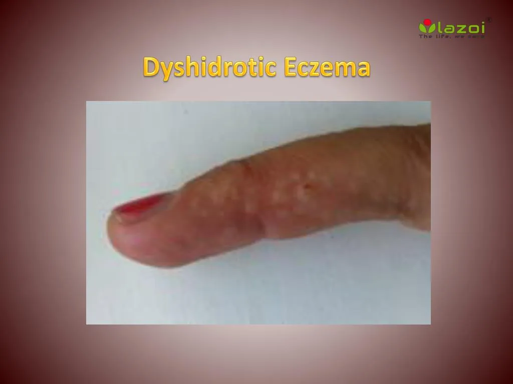 dyshidrotic eczema