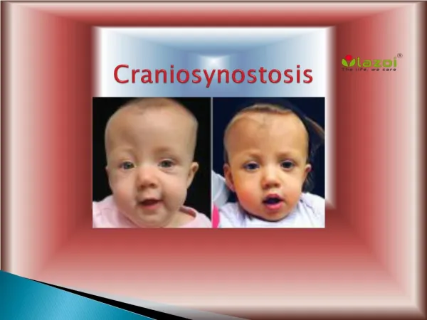 Craniosynostosis: Types, Causes, Symptoms, Diagnosis and Treatment